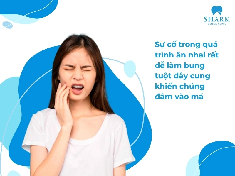 Ăn nhai không cẩn thận dễ bị xước niêm mạng do dây cung đâm vào má