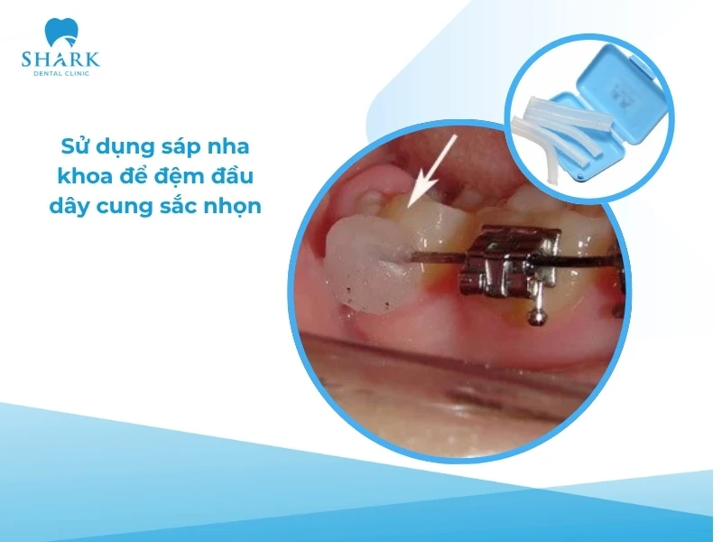 Sử dụng sáp nha khoa để tránh dây cung làm xước má