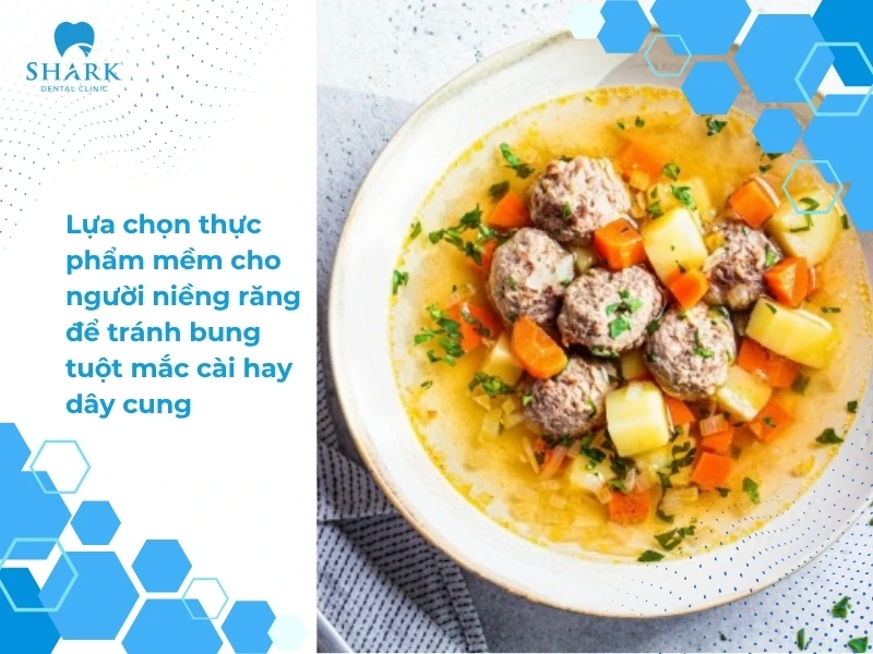 Có chế độ ăn uống khoa học trong khi niềng răng để tránh bung tuột dây cung