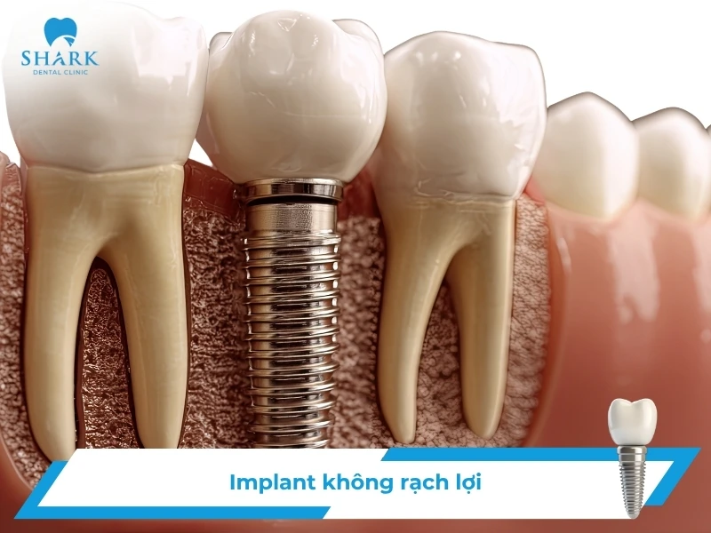 Trồng răng không rạch lợi