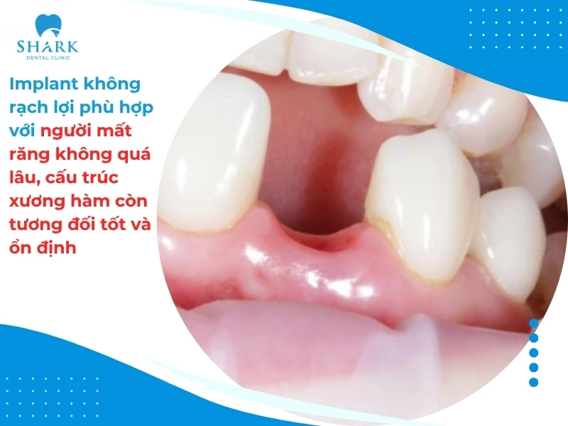 Phù hợp với người mất răng không quá lâu, cấu trúc xương hàm còn tương đối tốt và ổn định