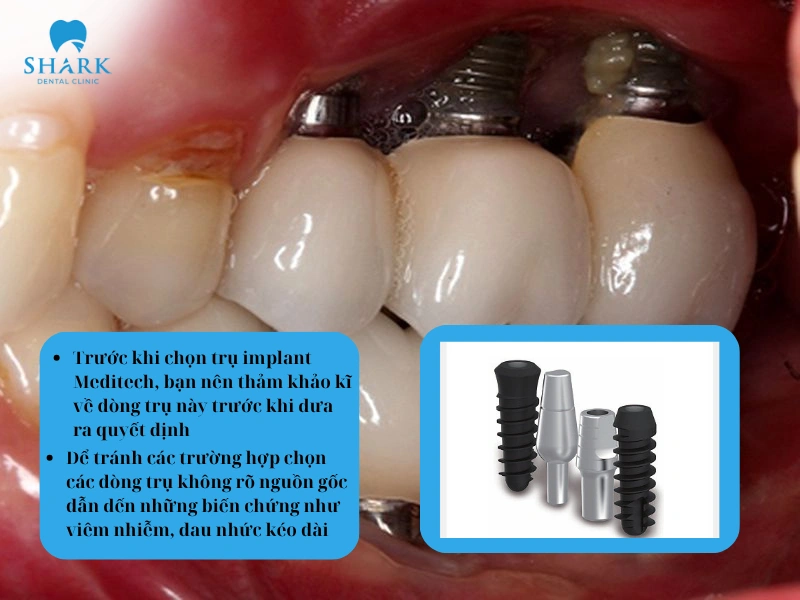 Trước khi lựa chọn trụ Implant Meditech, bạn nên tham khảo kỹ về dòng trụ này trước khi đưa ra quyết định