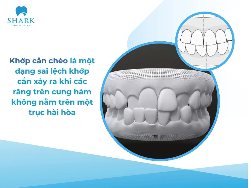 Khớp cắn chéo