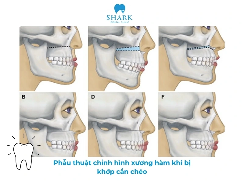 Phẫu thuật để chỉnh là xương