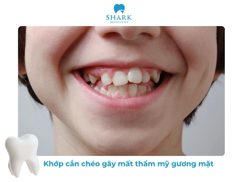 Gương mặt trông mất cân đối khi bạn có khớp cắn chéo