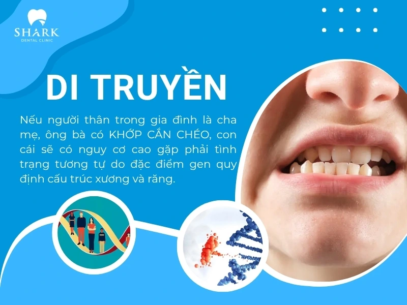Di truyền là yếu tố hàng đầu dẫn đến khớp cắn chéo