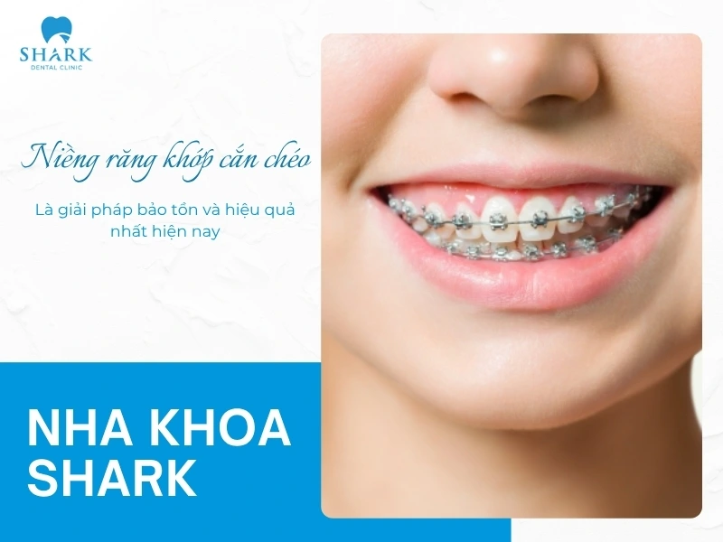 Niềng răng là giải pháp khắc phục sai lệch khớp cắn hiệu quả mà vẫn bảo tồn cấu trúc răng thật