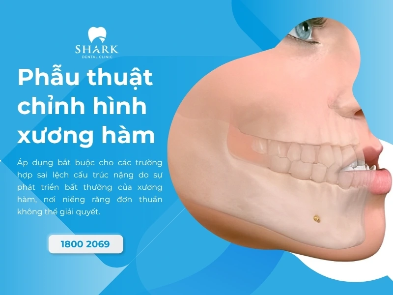Phẫu thuật xương hàm để khắc phục các ca sai lệch khớp cắn khó