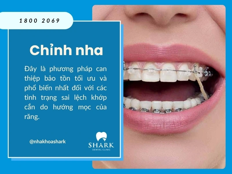 Chỉnh nha khắc phục sai lệch khớp cắn