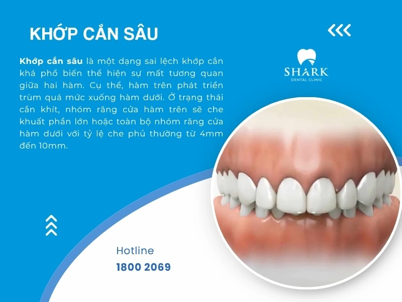 Khớp cắn sâu