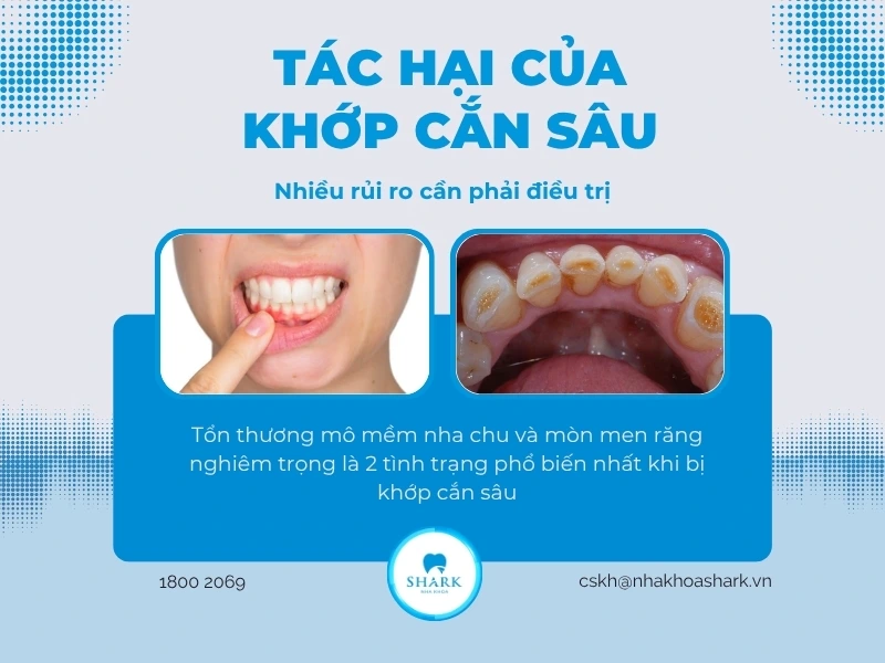 Khớp cắn sâu lâu ngày sẽ ảnh hưởng nghiêm trọng đến sức khỏe răng miệng