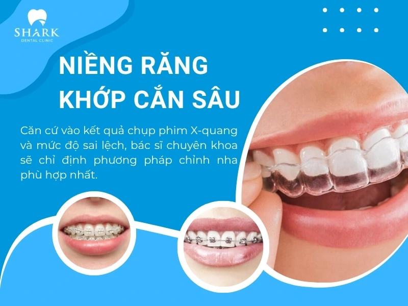 Các phương pháp chỉnh nha phổ biến hiện nay