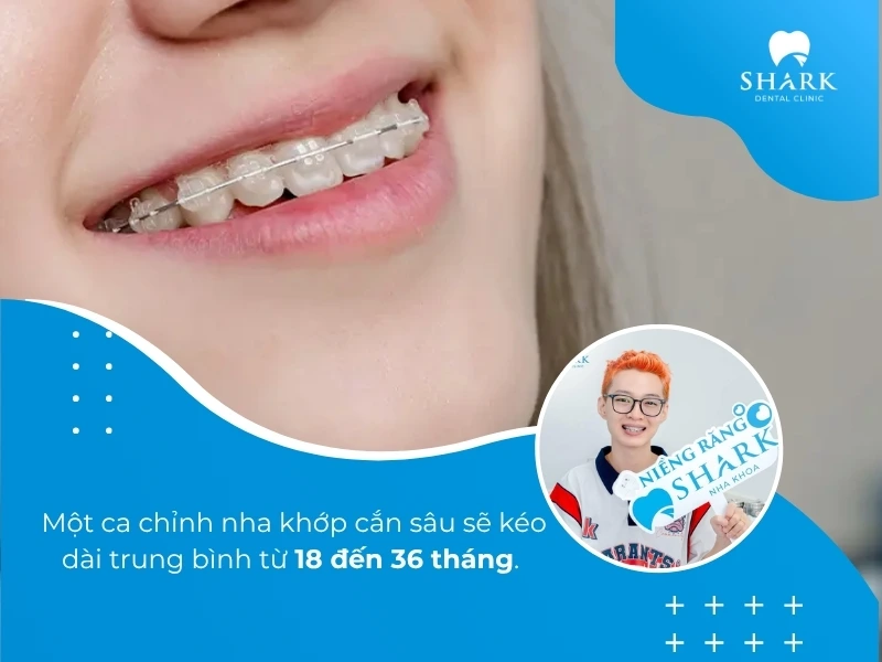 Niềng răng khớp cắn sâu thường kéo dài hơn 18 tháng