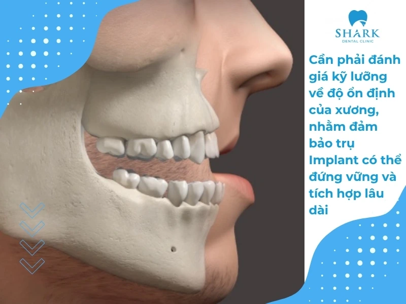 Người tiểu đường có trồng răng Implant được không? Vì sao? 16 Cần phải đánh giá kỹ lưỡng về độ ổn định của xương, nhằm đảm bảo trụ Implant có thể đứng vững và tích hợp lâu dài