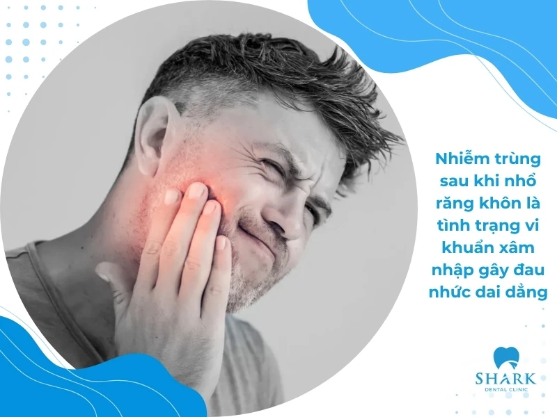 10 Dấu hiệu nhiễm trùng sau khi nhổ răng khôn và cách xử lý 16 Nhiễm trùng sau khi nhổ răng khôn gây ra nhiều biến chứng nguy hiểm