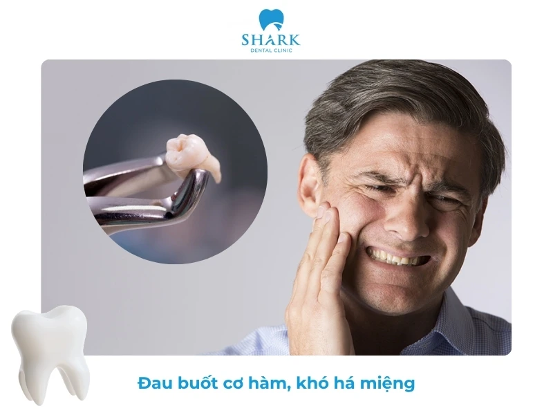 10 Dấu hiệu nhiễm trùng sau khi nhổ răng khôn và cách xử lý 23 Đau hàm dữ dội sau khi nhổ răng khôn