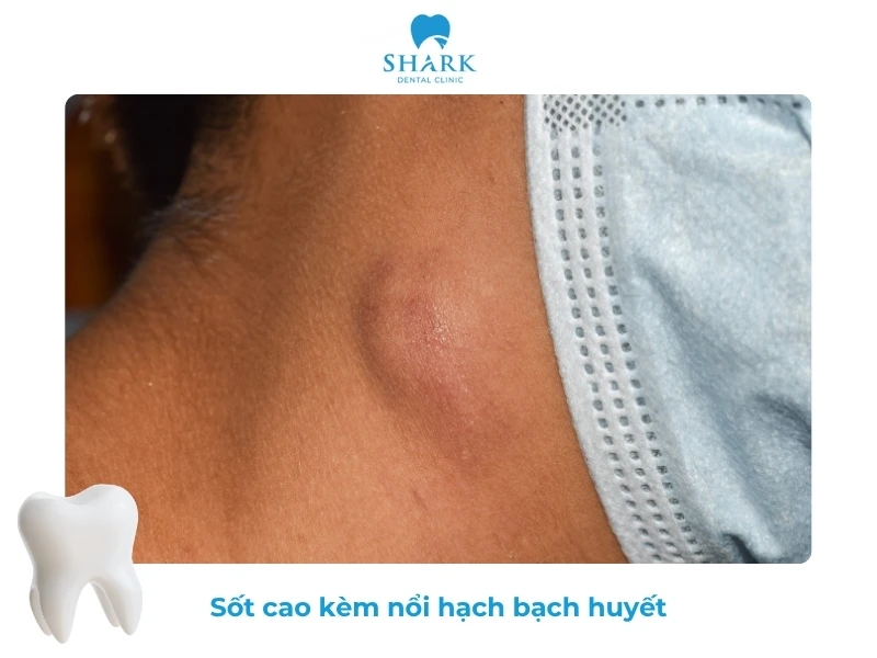 10 Dấu hiệu nhiễm trùng sau khi nhổ răng khôn và cách xử lý 24 Nổi hạch sau khi nhổ răng khôn kèm sốt cao