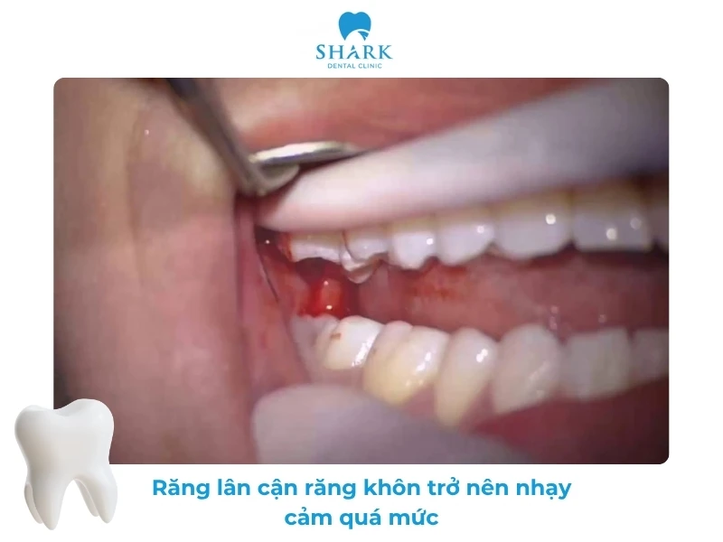 10 Dấu hiệu nhiễm trùng sau khi nhổ răng khôn và cách xử lý 26 Các răng lân cận đau và thường nhạy cảm khi ăn uống