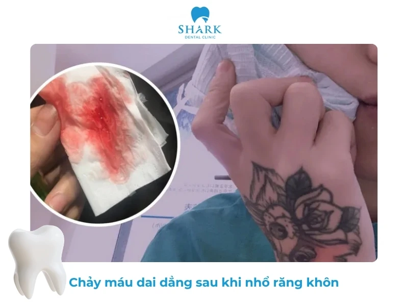 10 Dấu hiệu nhiễm trùng sau khi nhổ răng khôn và cách xử lý 17 Chảy máu tại vị trí răng khôn đã nhổ liên tục