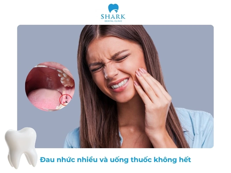 10 Dấu hiệu nhiễm trùng sau khi nhổ răng khôn và cách xử lý 18 Đau nhức nhiều mà không thuyên giảm sau khi đã nhổ răng số 8