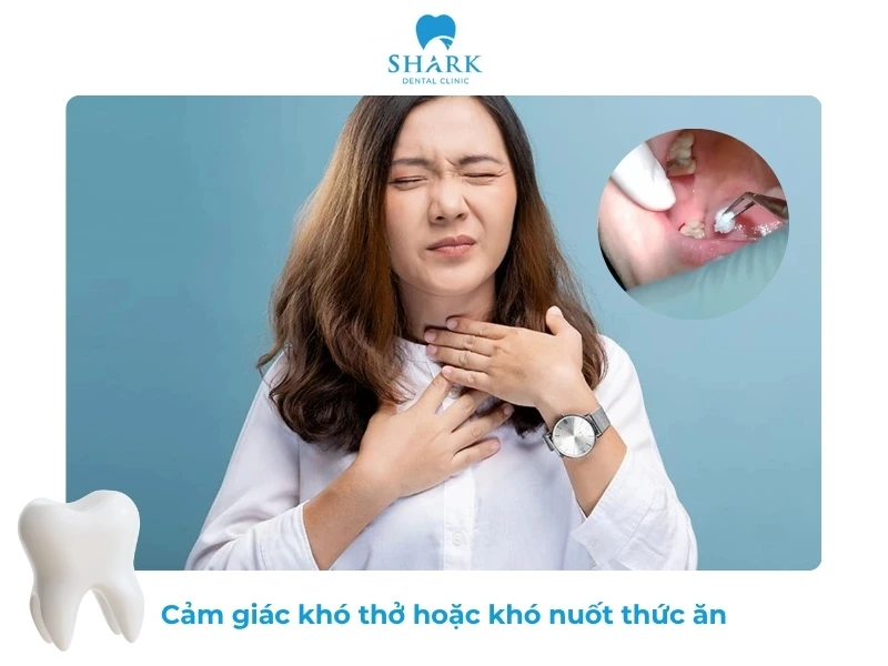 10 Dấu hiệu nhiễm trùng sau khi nhổ răng khôn và cách xử lý 19 Khó thở và đau khi nuốt thức ăn là biến chứng nguy hiểm sau khi nhổ răng khôn