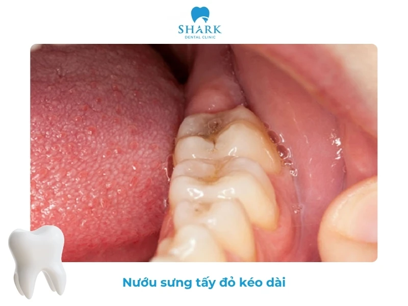 10 Dấu hiệu nhiễm trùng sau khi nhổ răng khôn và cách xử lý 21 Nướu sưng tấy sau khi nhổ răng khôn là dấu hiệu nhiễm trùng