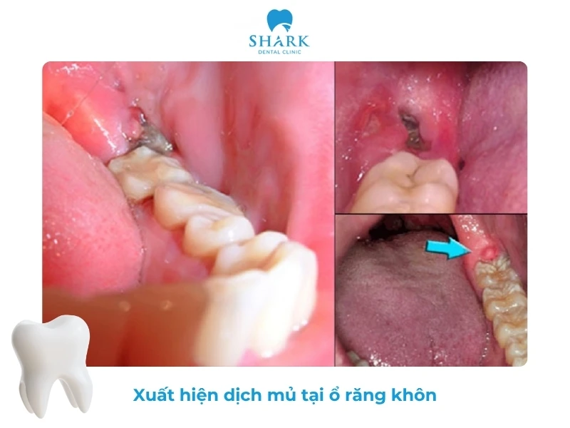 10 Dấu hiệu nhiễm trùng sau khi nhổ răng khôn và cách xử lý 22 Xuất hiện mủ tại vị trí nhổ răng khôn