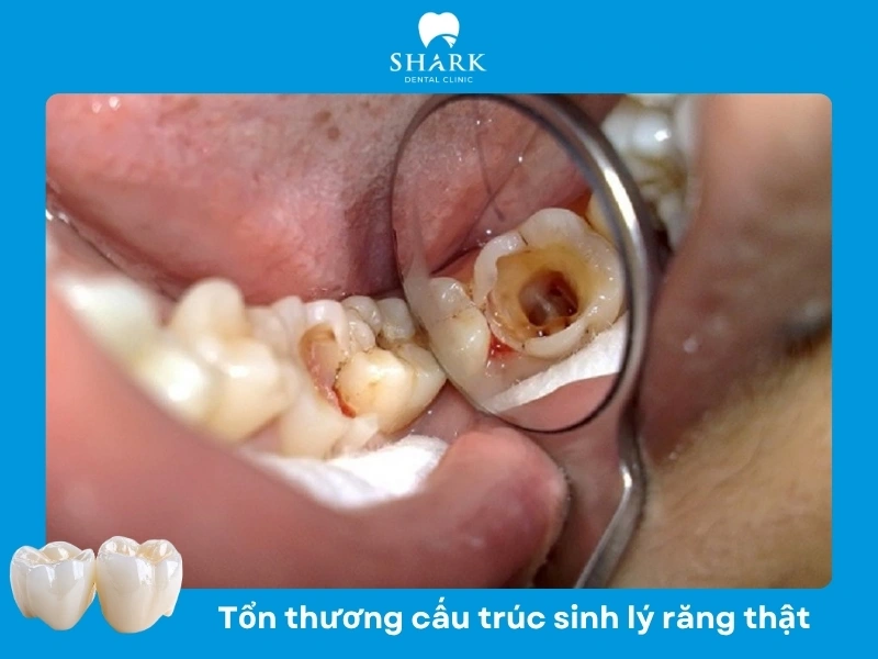 Làm răng sứ cần mài răng vì thế không thể phục hình lại răng thật sau khi đã mài