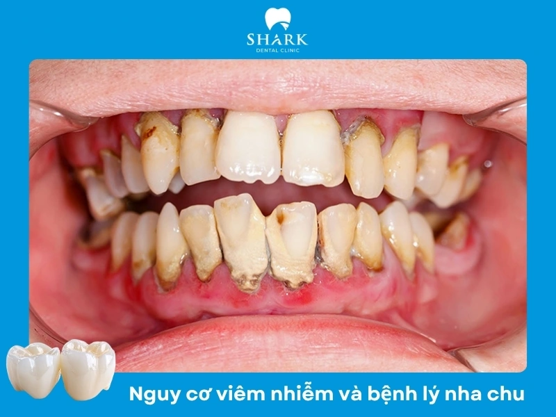 Cấu trúc răng bị mài mòn vì thế dễ gây ra viêm nhiễm nếu không chăm sóc kỹ