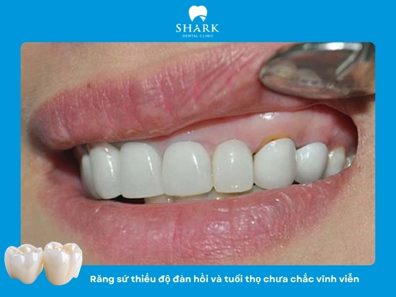 Răng sứ có tuổi thọ và thời gian sử dụng có thể giảm nếu chăm sóc sao cách