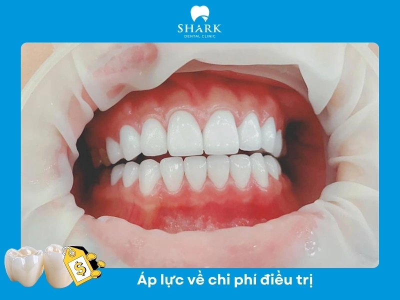 Bọc răng sứ là dịch vụ tốn kém tùy theo loại sứ mà khách hàng lựa chọn