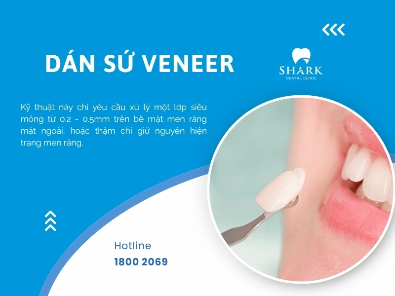 Dán sứ Veneer để giảm bớt áp lực tài chính