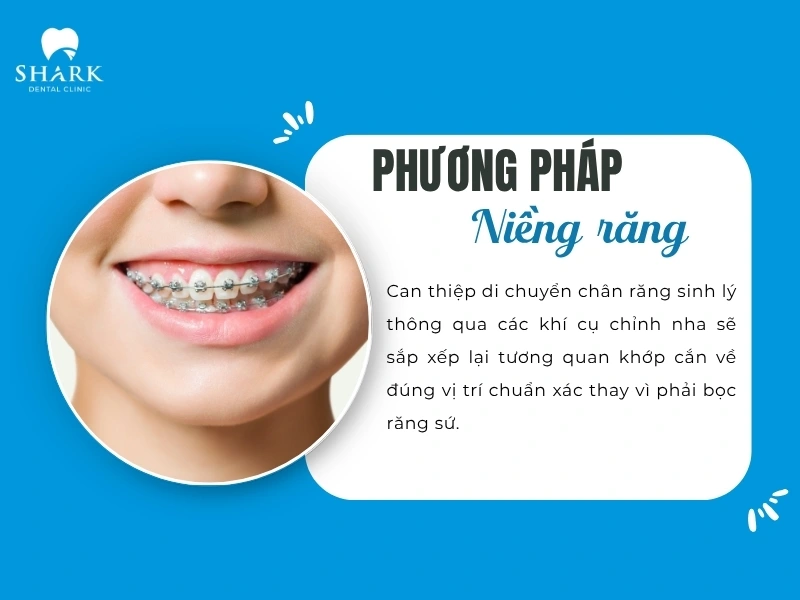 Niềng răng là giải pháp cần thời gian để khắc phục các tình trạng răng lệch lạc