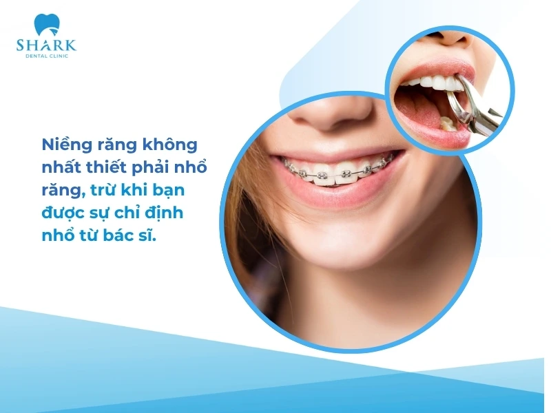 Niềng răng không nhổ răng vẫn có thể thực hiện được