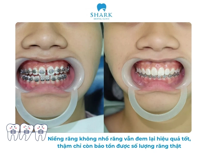 Niềng răng không nhổ răng giúp bảo tồn răng thật tốt