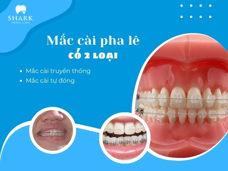 Mắc cài pha lê gồm 2 loại là thun buộc và tự đóng