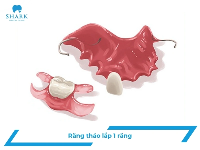 Răng giả tháo lắp 1 chiếc