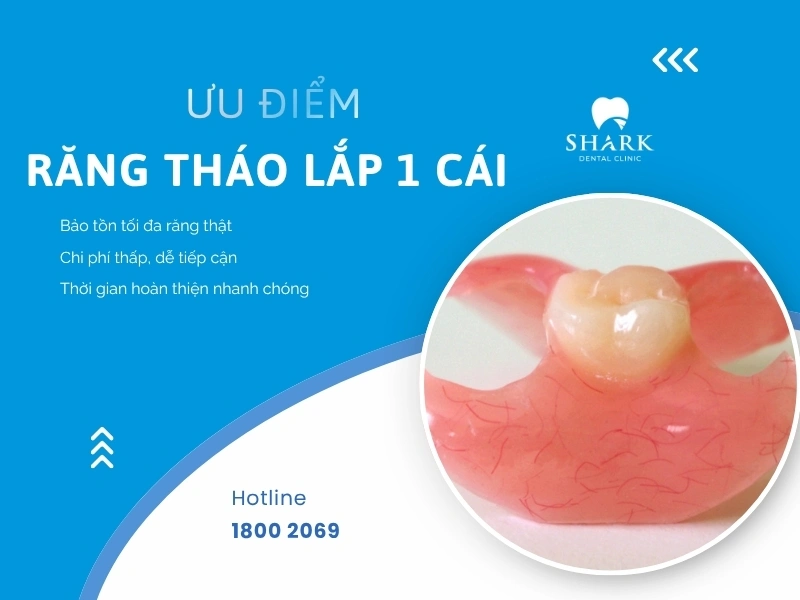 Răng giả 1 chiếc có ưu điểm nhưng cũng tồn tại nhiều nhược điểm