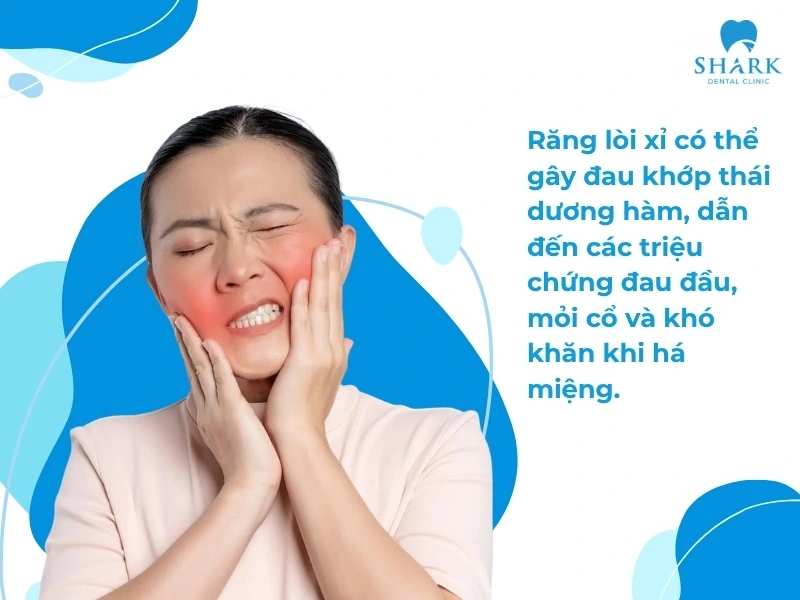 Răng lòi xỉ lâu năm sẽ dễ dẫn đến đau thái dương hàm