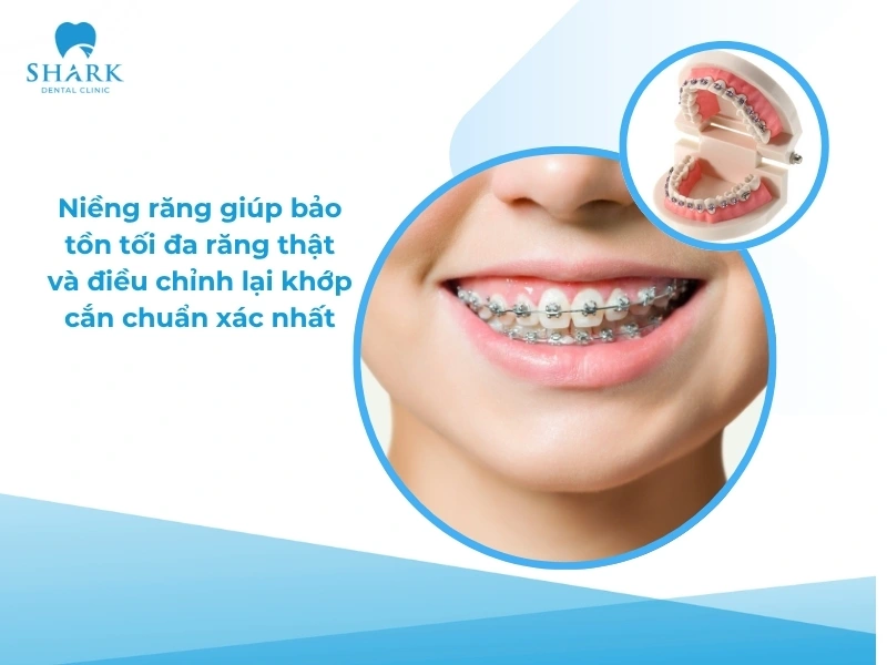 Niềng răng là cách khắc phục răng lòi xỉ hiệu quả để bảo tồn răng thật