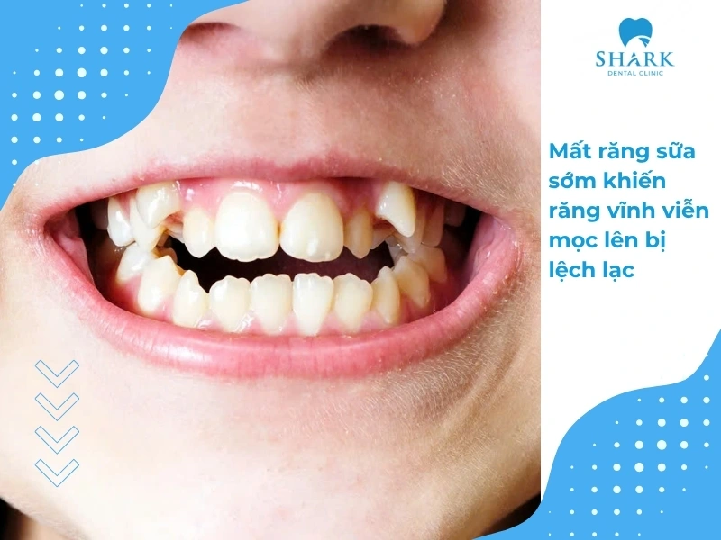 Mất răng sữa sớm dễ dẫn đến sai lệch khớp cắn gây hiện tượng lòi xỉ