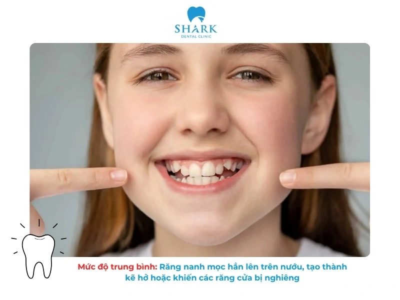 Mức độ trung bình: Răng nanh mọc hẳn lên trên nướu, tạo thành kẽ hở hoặc khiến các răng cửa bị nghiêng