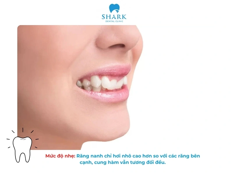 Mức độ nhẹ: Răng nanh chỉ hơi nhô cao hơn so với các răng bên cạnh, cung hàm vẫn tương đối đều