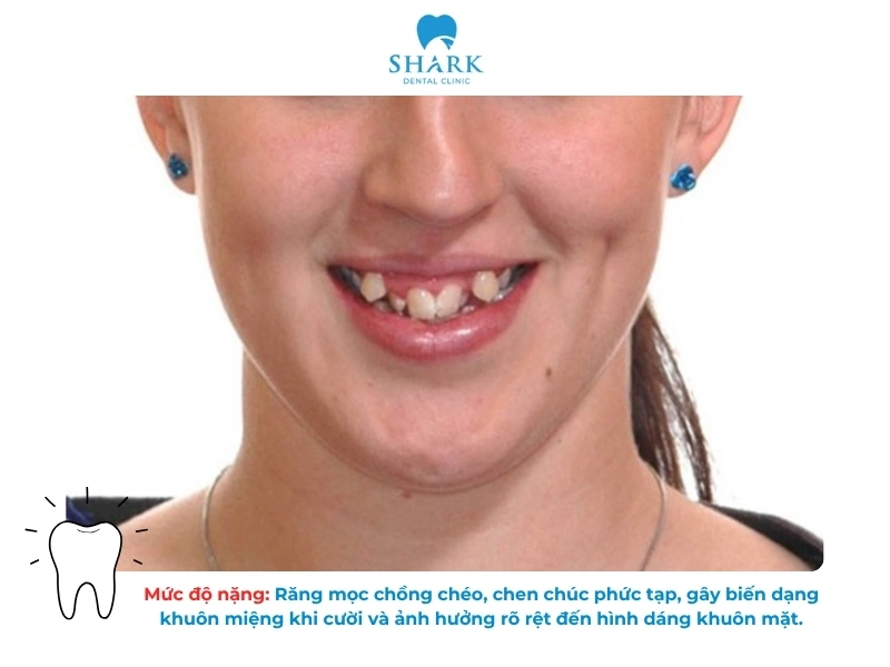 Mức độ nặng: Răng mọc chồng chéo, chen chúc phức tạp, gây biến dạng khuôn miệng khi cười và ảnh hưởng rõ rệt đến hình dáng khuôn mặt