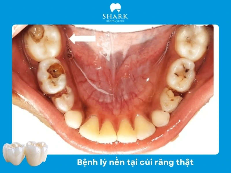 Bệnh lý viêm nhiễm trong cùi răng thật