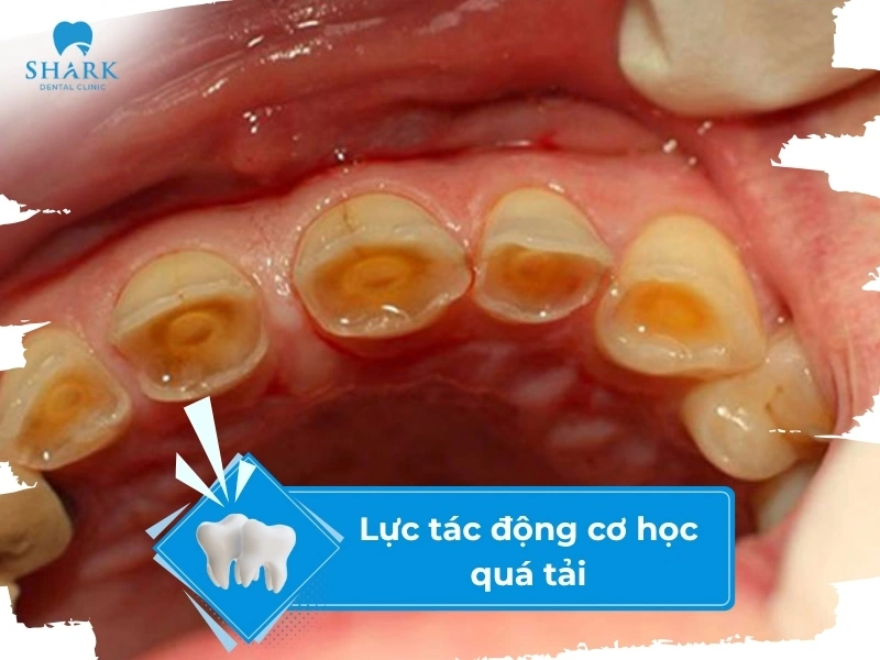 Lực ăn nhai quá mạnh khiến răng sứ dễ bị rơi