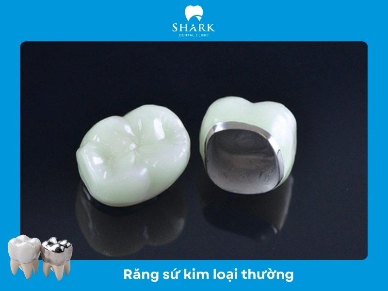 Răng sứ kim loại thường