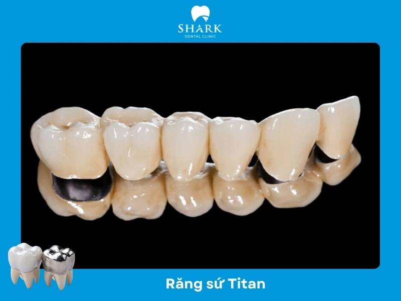 Răng sứ Titan