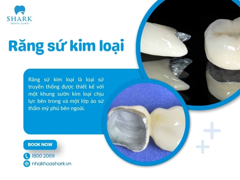 Răng sứ kim loại
