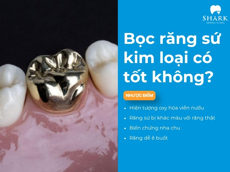 Sứ kim loại có tốt và lành tính không?